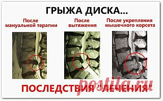 Как вылечить грыжу позвоночника и не остаться инвалидом (обучающий видеоурок) Видеоуроки онлайн - бесплатно