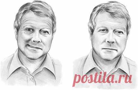 Как убрать асимметрию лица после инсульта.