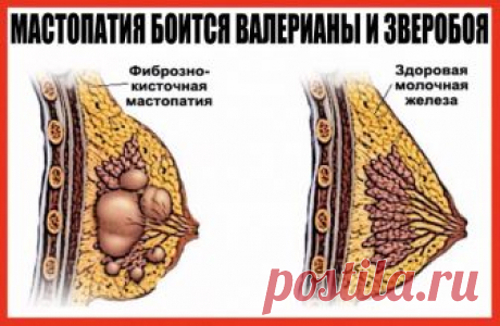 МАСТОПАТИЯ БОИТСЯ ВАЛЕРИАНЫ И ЗВЕРОБОЯ
Услышав от врачей диагноз «мастопатия», многие женщины впадают в отчаяние. И не случайно. Большинство не знает, как это заболевание лечить и как с ним жить. Доктора зачастую никакого лечения не предлагают. Советуют лишь проверять молочные железы каждый год, а вот если уплотнение начнет расти, тогда … придется, видимо, оперировать. Утешение, сами понимаете, слабое. А вот народная медицина знает немало естественных средств, с помощью ко...