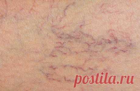 Натуральные средства для предотвращения варикоза - Шаг к Здоровью