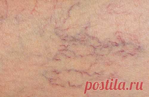 Натуральные средства для предотвращения варикоза - Шаг к Здоровью