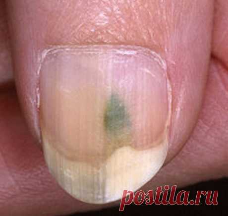 Белые и темные пятна на ногтях ног или рук. Причины, фото