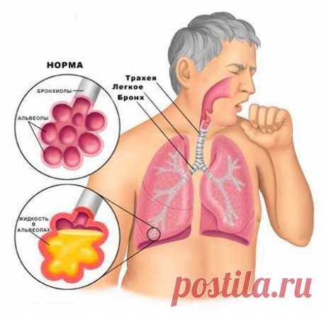 Народные средства от кашля. Вывод мокроты. Актуально