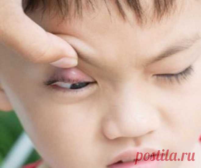 Какой заговор от ячменя на глазу читать самой? Заговоры от ячменя на кукиш, воду, хлеб, зерна: описание обряда, слова заговора 100% Заговоры и заклинания, Подборка обрядов