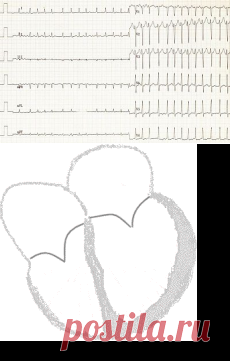 Фибрилляция предсердий — Википедия
