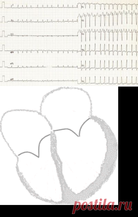 Фибрилляция предсердий — Википедия