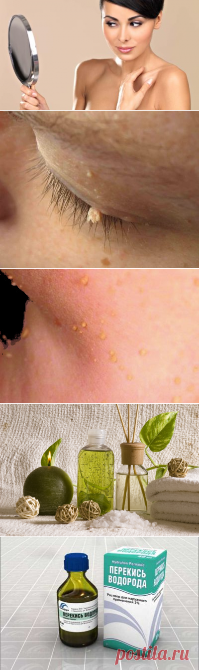 Как избавиться от папиллом в домашних условиях за 1 день