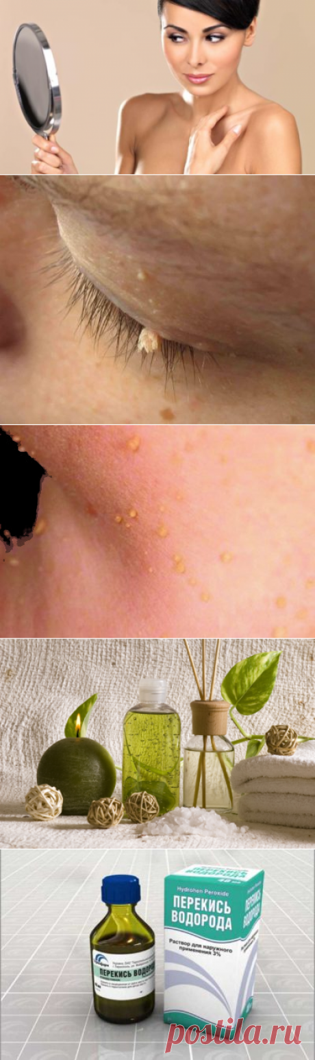 Как избавиться от папиллом в домашних условиях за 1 день