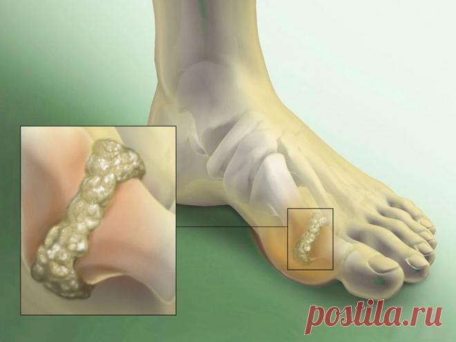 Действенные методы лечения. Держите под контролем уровень мочевой кислоты! Беспокоит боль в суставах? Или ты заметил, что суставы пальцев воспалены? Таким образом твой организм бьет тревогу и сигнализирует о том, что, вероятнее всего, у тебя повышенный уровень мочевой кислоты. В таком случае, помимо выполнения обязательных рекомендаций врача, следует обратить внимание на свой рацион.