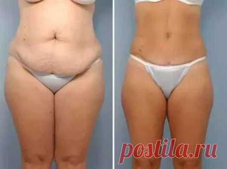 Это средство из аптеки за 150 рублей позволило мне убрать дряблую кожу и жир на животе за 2 недели | Решила похудеть | Яндекс Дзен