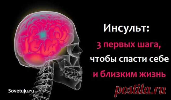 Инсульт: 3 первых шага,чтобы спасти себе и близким жизнь
