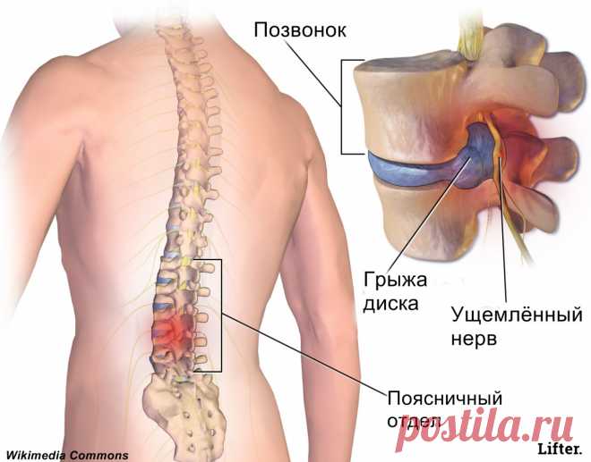 Комплекс ежедневных упражнений при грыже