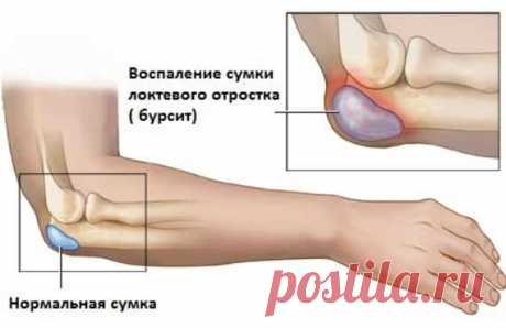 Бурсит — он печально знаменит. Как лечится воспаление, когда к врачу и что можно сделать дома, если врачи так и не помогли