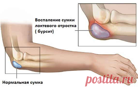 Бурсит — он печально знаменит. Как лечится воспаление, когда к врачу и что можно сделать дома, если врачи так и не помогли
