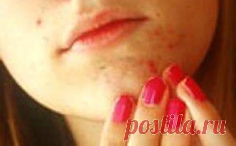 Гнойные прыщи на лице, прыщи на губах, прыщи на переносице | vita-jizn.net