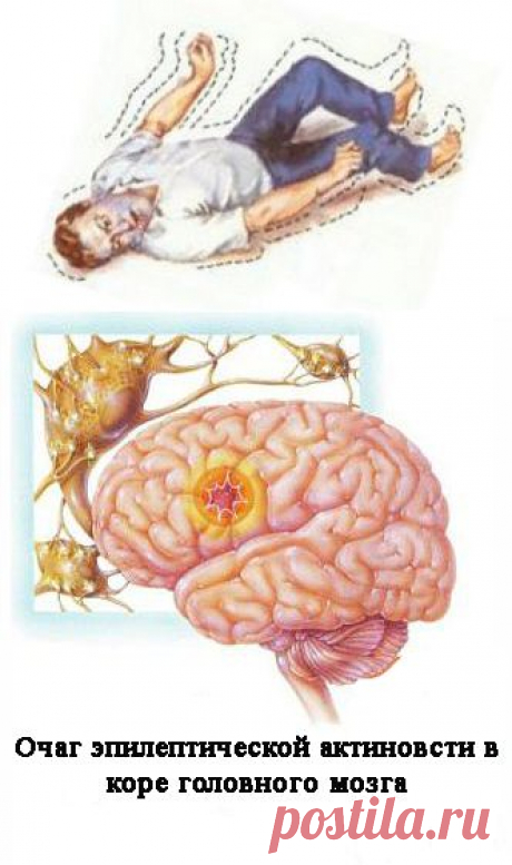 Эпилепсия: причины, симптомы, диагностика, лечение