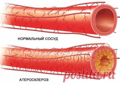 Способы чистки сосудов головного мозга в домашних условиях