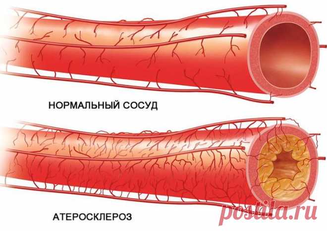 Способы чистки сосудов головного мозга в домашних условиях