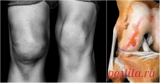 Подруга потратила две зарплаты, чтобы вылечить колени. Лишь это простое средство остановило артроз! — СОВЕТНИК