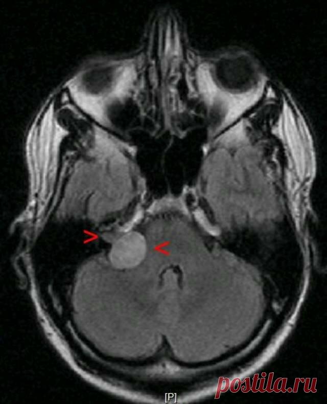Шваннома слухового нерва мрт. Невринома слухового нерва макропрепарат. Невринома слухового нерва. Невринома преддверно-улиткового (viii) нерва. Шваннома слухового нерва кт.