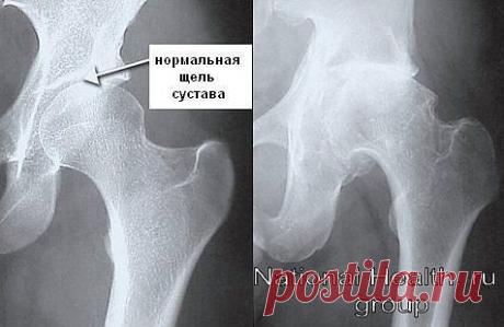 коксартроз тазобедренных суставов - 705 картинок. Поиск@Mail.Ru