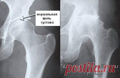 коксартроз тазобедренных суставов - 705 картинок. Поиск@Mail.Ru