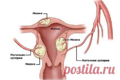 ЛЕЧЕНИЕ МИОМЫ МАТКИ БЕЗ ОПЕРАЦИИ