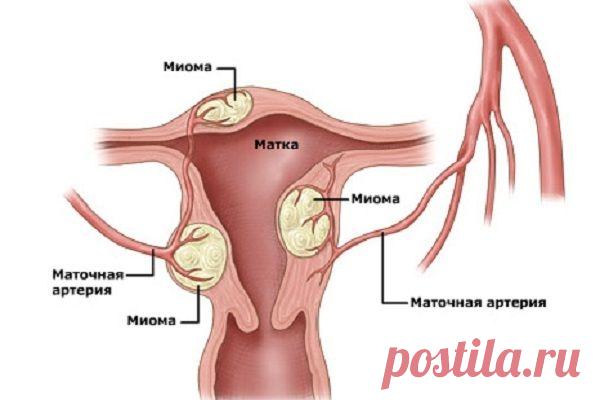 ЛЕЧЕНИЕ МИОМЫ МАТКИ БЕЗ ОПЕРАЦИИ