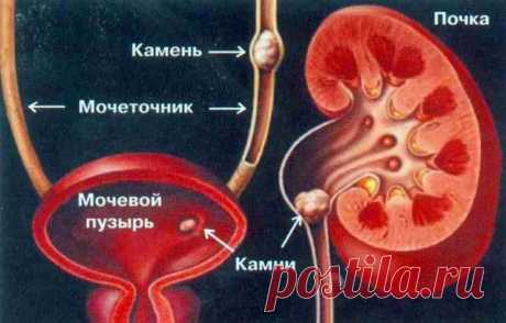 Посмотрите сами, как камни выходят из почек с помощью этого натурального средства!