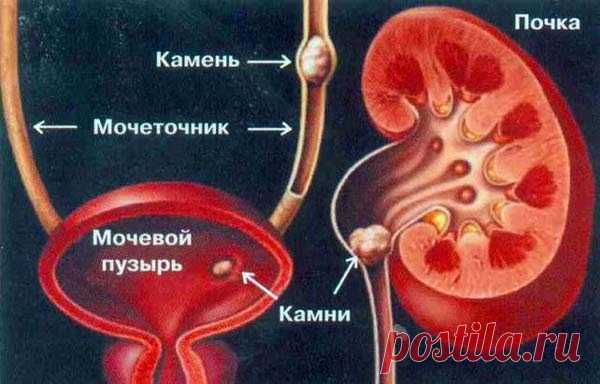 Посмотрите сами, как камни выходят из почек с помощью этого натурального средства!