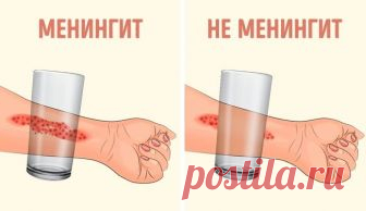 Эти 8 признаков менингита обязан знать каждый родитель! - interesno.win Менингит является заболеванием, которое поражает головной и спинной мозг. Что самое интересное,...