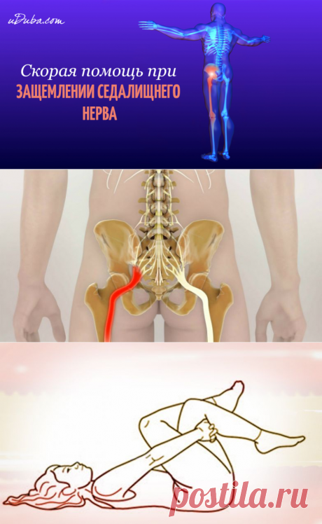 Как разблокировать седалищный нерв: 2 простых способа снять боль.