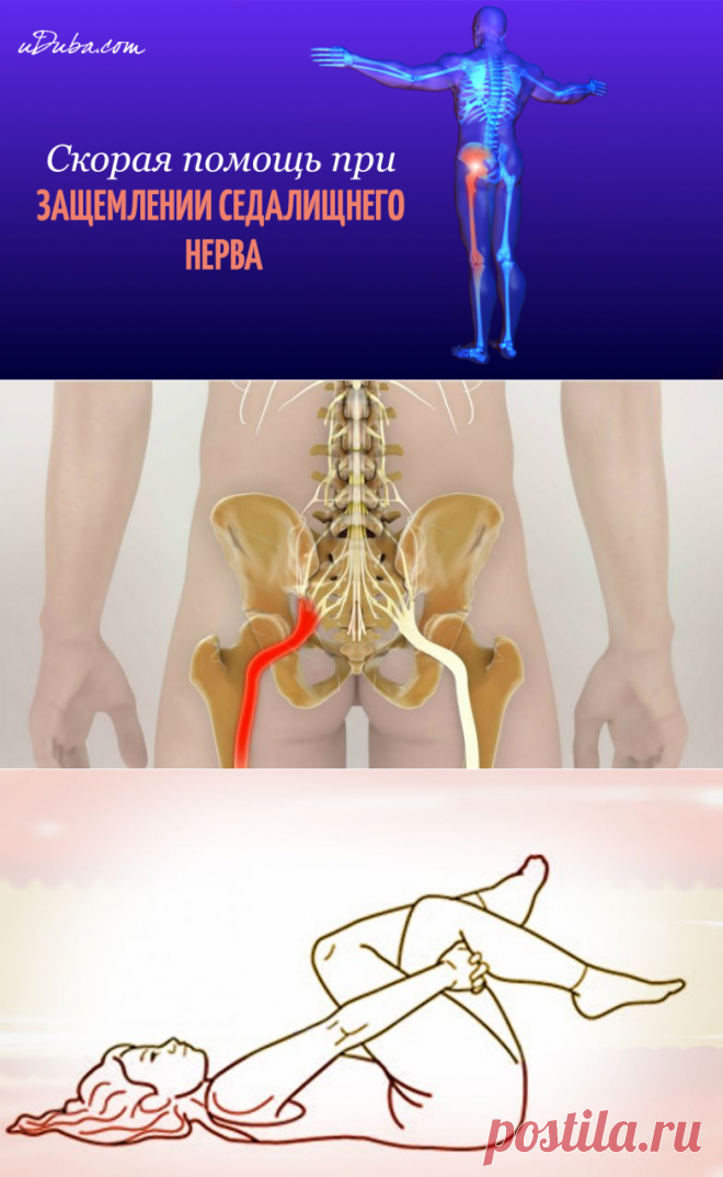 Как разблокировать седалищный нерв: 2 простых способа снять боль.