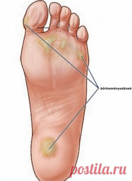 Как лечить натоптыши на подошве ног: народные средства и аптечные препараты для избавления от недуга на ступнях в домашних условиях