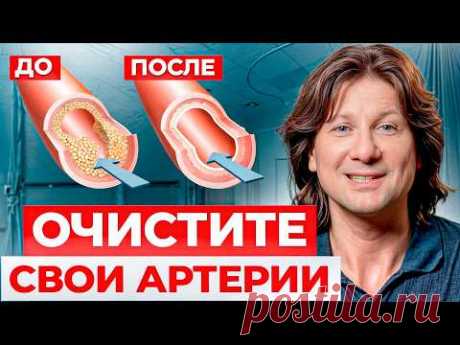 ПЕРВЫЕ симптомы атеросклероза! / Как БЫСТРО избавиться от холестериновых бляшек?