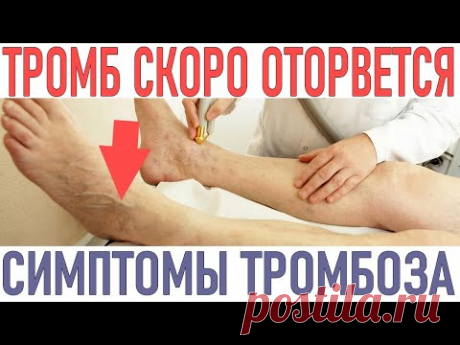 СРОЧНО ОБРАТИТЕСЬ К ВРАЧУ! Вот что указывает на то, что у вас тромбоз.