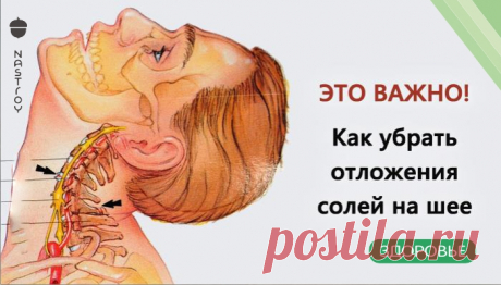 Убираем отложения солей на шее Отложение солей на шее называют остеохондрозом шейного отдела позвоночника. Вследствие того, что шейный отдел позвоночника является весьма важной частью ор...
