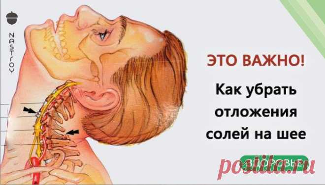 Убираем отложения солей на шее Отложение солей на шее называют остеохондрозом шейного отдела позвоночника. Вследствие того, что шейный отдел позвоночника является весьма важной частью ор...