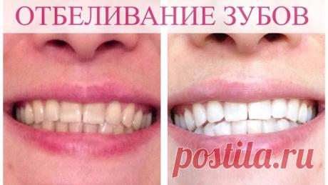 ОТБЕЛИВАНИЕ ЗУБОВ