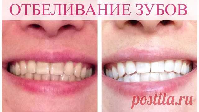 ОТБЕЛИВАНИЕ ЗУБОВ