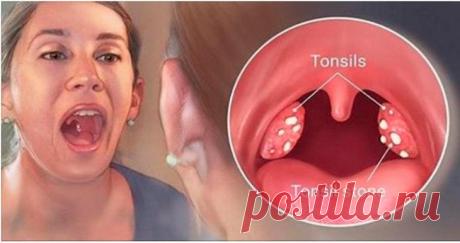 Лечим тонзиллит народными средствами то из нас не страдал (особенно в детстве) мучительными болями в горле, когда сложно глотать и разговаривать! Это заболевание называет по-разному: ангина, тонзиллит.Как облегчить состояние в ходе болез...