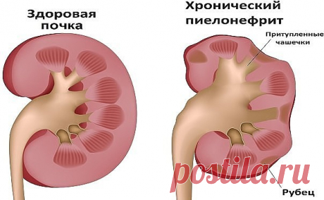НАРОДНЫЙ РЕЦЕПТ ДЛЯ ЛЕЧЕНИЯ ПОЧЕК
