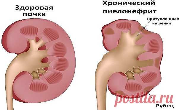 НАРОДНЫЙ РЕЦЕПТ ДЛЯ ЛЕЧЕНИЯ ПОЧЕК