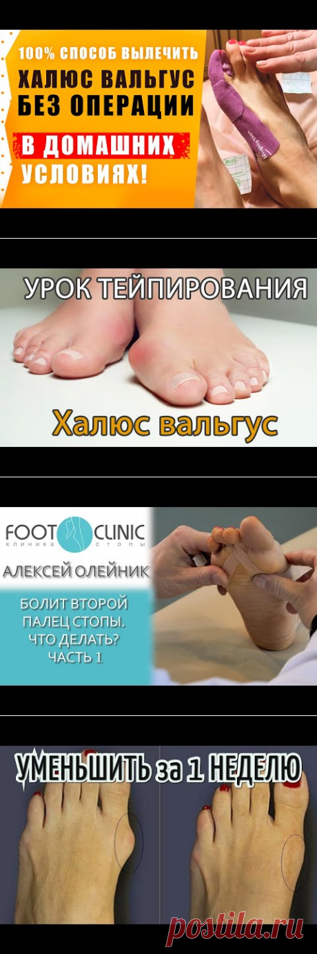 Халюс Вальгус – Лечение без операции в домашних условиях ! Подагра. - YouTube