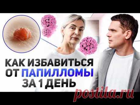 Папилломы и Бородавки. Как ЗА 1 ДЕНЬ Избавиться От Них НАВСЕГДА?