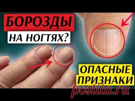 ВЕРТИКАЛЬНЫЕ БОРОЗДЫ НА НОГТЯХ? ЭТО МОЖЕТ СИГНАЛИЗИРОВАТЬ О СЕРЬЕЗНЫХ ПРОБЛЕМАХ! Узнайте, каких.