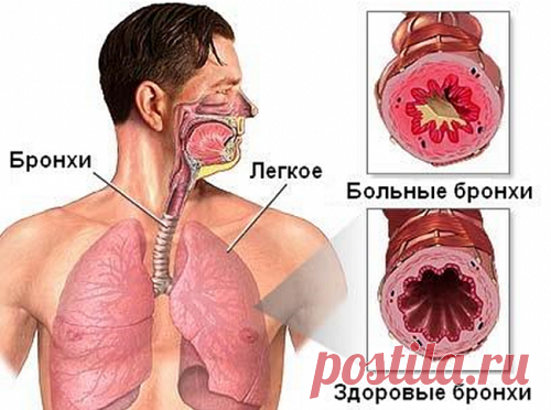 Хронический бронхит — лечение народными средствами — Здоровое Долголетие