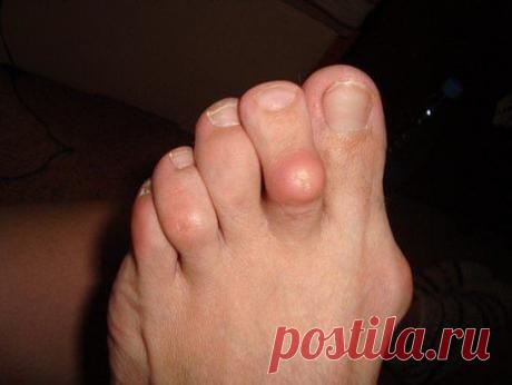 Одноклассники Наросты на суставах