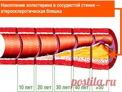 ЛЕЧЕНИЕ АТЕРОСКЛЕРОЗА СОГЛАСНО МЕНЮ ПРАВИЛЬНОГО ПИТАНИЯ