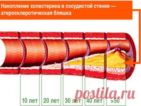 ЛЕЧЕНИЕ АТЕРОСКЛЕРОЗА СОГЛАСНО МЕНЮ ПРАВИЛЬНОГО ПИТАНИЯ
